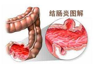 结肠炎怎么治疗好?